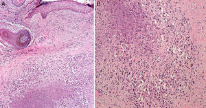 A. H-E ×100. Dermatitis nodular granulomatosa con granuloma en la dermis media, constituido por histiocitos epitelioides rodeando una zona de necrosis caseosa. B. H-E ×200. Granulomas tuberculoides con necrosis caseosa.