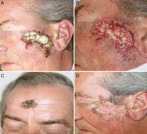 A y B. Aspecto de las lesiones con intensa reacción inflamatoria, formación de costras y supuración al mes del inicio del tratamiento antituberculoso. C y D. A los 4 meses tras el inicio del tratamiento.