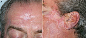 A y B. Resultado clínico tras 12 meses de tratamiento antituberculoso.