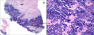 A. Biopsia de 5mm del nódulo nasal. Se observa una proliferación neoplásica difusa en dermis profunda, hipodermis y capa muscular (H-E×10). B. Las células neoplásicas son pequeñas, monomorfas, redondas, con escaso citoplasma y núcleos basófilos (H-E×400).