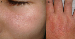 A. Placas eritematoedematosas, con formación de micropápulas en superficie y ligera descamación, localizadas en la cara. B. Mismo tipo de lesiones con liquenificación en el dorso de la mano.