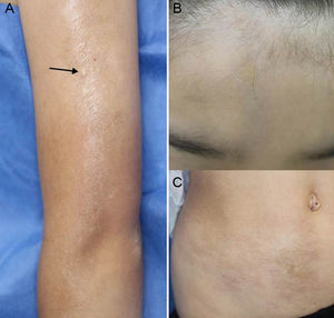 (A) Clinical appearance of the linear sclerotic plaque on the patient