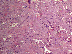 Histopatología: lesión mal delimitada localizada en la dermis, compuesta por fascículos de células fusiformes que se distribuyen irregularmente y se entrelazan con las fibras de colágeno. Hematoxilina-eosina×100.