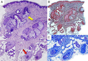 Skin specimen biopsy of alopecic area. (A) Normal epidermis with no inflammatory infiltrate. Miniaturized hair follicles (red arrow), atrophy of the sebaceous glands (yellow arrow) (hematoxylin eosin, original magnification 100×). (B) Normal dermal elastic fibers (orcein, original magnification 40×). (C) Perifollicular fibrosis (trichome, original magnification 100×).