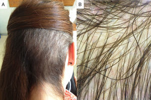 (A) Complete repopulation of the alopecic area after 3 months of follow-up. (B) Normal density of follicular openings with terminal hairs (original magnification 20×).