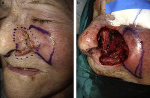 Carcinoma epidermoide en ala nasal izquierda: A) Lesión previa a la exéresis quirúrgica; B) Defecto quirúrgico tras la cirugía tumoral.
