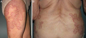 A y B. Muslo derecho y región lumbar con anterioridad al tratamiento.