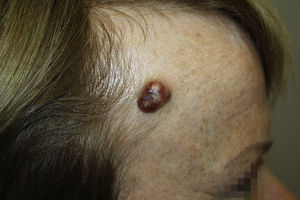 Imagen clínica: tumoración excrecente de 15mm de diámetro, bien delimitada en la región frontoparietal derecha con varios colores.