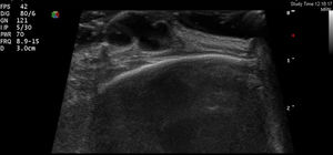 Imagen de ecografía cutánea: se observa una lesión hipoecoica lobulada localizada en la dermis superficial con discreto refuerzo posterior.