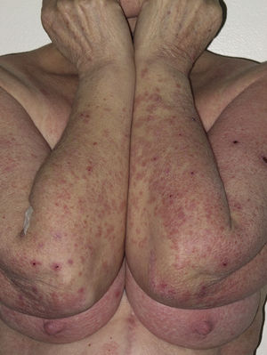 Placas eritematovioláceas excoriadas en paciente mujer con toxicodermia por telaprevir.