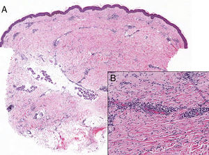 A. Panorámica en la que se observa disminución de los anejos con infiltrado inflamatorio superficial y profundo linfoplasmocitario intersticial y perivascular leve (hematoxilina-eosina×40). B. A mayor aumento detalle del engrosamiento del colágeno (hematoxilina-eosina×100).