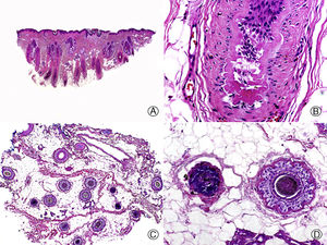 Efluvio telógeno por quimioterapia. A. Corte longitudinal donde se observan varios folículos pilosos en telogen rodeados por gruesas vainas conectivas perifoliculares (HE x10). B. Detalle de la anterior mostrando una membrana vítrea gruesa y arrugada alrededor de la maza en telogen (HE x200). C. El mismo caso estudiado en cortes transversales, donde se observan varias unidades foliculares (HE x20). D. Detalle de la anterior en la que se aprecia una vaina radicular externa arrugada rodeada de una gruesa membrana vítrea (HE x200).