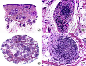 Alopecia areata. A. En cortes longitudinales se observa un infiltrado inflamatorio rodeando los bulbos de los folículos pilosos terminales (HE x10). B. Detalle de la anterior donde se observa que el infiltrado inflamatorio está compuesto mayoritariamente por linfocitos (HE x200). C. Cortes transversales del mismo caso mostrando un infiltrado inflamatorio alrededor del segmento inferior de varios de los folículos pilosos (HE x10). D. Detalle de la anterior que muestra un intenso infiltrado linfocitario (HE x200).