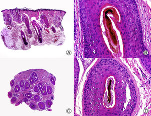Tricotilomanía. A. Cortes longitudinales donde se observan foliculos pilosos normales alternando con otros afectados (HE x10). B. Tricomalacia mostrando tallos pilosos pigmentados y arrugados en el canal folicular (HE x200). C. El mismo caso estudiado en cortes transversales (HE x10). D. Detalle de la anterior donde se observa un tallo piloso roto y con abundante pigmento (HE x200).