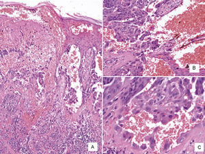 A. Imagen panorámica del melanoma angiomatoide (H-E ×100). B y C. Mayor aumento donde se ilustra que los espacios pseudovasculares están revestidos de células neoplásicas y numerosos eritrocitos extravasados (H-E ×200).