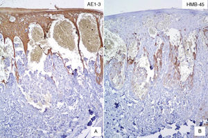 A. Inmunomarcación con queratina AE1-3 donde muestra la positividad en el epitelio y las células neoplásicas son negativas. B. Inmunomarcación con HMB-45, donde las células neoplásicas son positivas y el epitelio negativo.