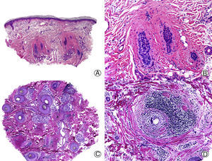 Alopecia cicatricial en una placa de lupus eritematoso cutáneo crónico. A. En cortes longitudinales se observan escasas unidades foliculares (HE x10). B. Fibrosis rodeando restos foliculares (HE x200). C. El mismo caso en cortes transversales (HE x20). D. Fibrosis concéntrica alrededor de restos foliculares (HE x200).
