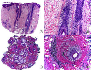 Liquen plano folicular. A. En cortes longitudinales se observa infiltrado perifolicular (HE x10). B. A mayor aumento se observan linfocitos salpicando el epitelio folicular (HE x200). C. El mismo caso estudiado en cortes transversales (HE x20). D. A mayor aumento se observa una fibrosis concéntrica perifolicular e infiltrado linfocitario en la periferia (HE x200).