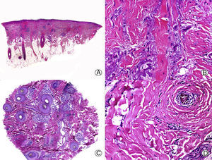 Pseudopelada de Brocq de larga evolución. A. Visión panorámica donde se observan columnas de fibrosis reemplazando a los folículos (HE x10). B. Detalle de la anterior mostrando fibrosis vertical entremezclada con elastosis actínica (HE x200). C. Corte transversal del mismo caso en el que se observan varias unidades foliculares (HE x20). D. A mayor aumento se aprecia fibroplasia concéntrica alrededor de restos foliculares (HE x200).