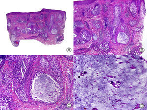Alopecia mucinosa. A. Visión panorámica (HE x10). B. A mayor aumento se observan lagos de mucina en el interior de los folículos pilosos (HE x20). C. Mayor aumento mostrando mucina entre los queratinocitos del epitelio folicular y un gran lago de mucina (HE x200). D. Detalle del material basófilo granular en el interior del epitelio folicular (HE x400).