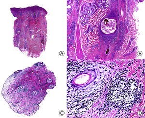 Foliculitis decalvante. A.Visión panorámica mostrando varios folículos pilosos rotos con fibrosis perifolicular (HE x10). B. Detalle de la anterior donde se observa un quiste infundibular rodeado de infiltrado inflamatorio y debajo un tallo piloso pigmentado rodeado de células gigantes multinucleadas (HE x200). C. Cortes transversales mostrando fibrosis perifolicular y manguitos de infiltrado alrededor de los folículos pilosos (HE x20). D. A mayor aumento se observa que el infiltrado está constituido por linfocitos y células plasmáticas (HE x200).