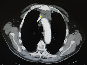 La TAC muestra un tumor en el mediastino anterior (MT) con compresión de la vena cava superior (flecha).