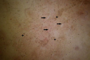 Dermatoscopia: estrías de Wickham (flechas) junto con puntos y glóbulos marrón-grisáceos siguiendo las estrías de Wickham o agrupados en los centros deprimidos de las mismas en forma de ashy holes (asteriscos).