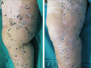 A. Aparición de forma explosiva de múltiples metástasis cutáneas de melanoma en el miembro inferior. B. Respuesta clínica un año después de la aplicación de electroquimioterapia. Obsérvese el frecuente fenómeno de halo nevus resultante.