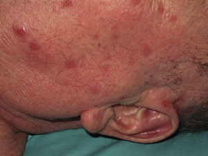 Leishmaniasis cutánea con lesiones múltiples.