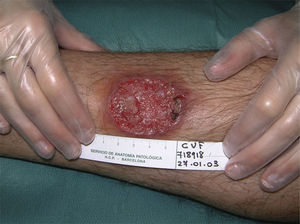 Leishmaniasis cutánea ulcerada importada centroamericana.