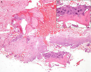 A. Fragmentos de cartílago elástico con focos de osificación; la dermis no muestra alteraciones (hematoxilina-eosina ×4). B. A mayor detalle se observan los focos de osificación con formación de trabéculas óseas maduras (hematoxilina-eosina ×20).