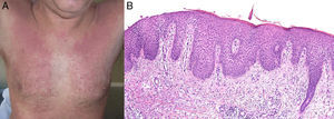 A. Exantema eritematoso confluente con respeto de los pliegues cutáneos. B. H-E ×10: patrón de dermatitis espongiótica subaguda.