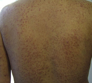 Nódulos eritemato-marronáceos bien delimitados de consistencia elástica en la espalda.