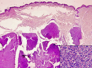 Biopsia excisional cutánea (H&E × 40). Infiltración dérmica y tejido adiposo por hepatocarcinoma. Contacta con margen quirúrgico profundo.