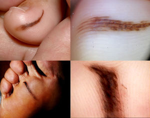 Clinical (A, B) and dermoscopic findings (C, D) of 2 of the 9 longitudinal nevi on the sole.