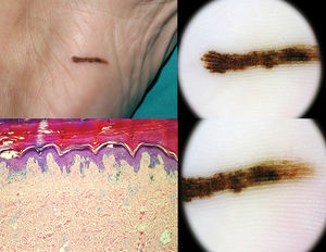 (A) One melanoma in situ was found among the 9 reported lineal nevi. (B) Histological study of the lesion was consistent with melanoma in situ (H–E×10). (C, D) The lesion showed a characteristic dermoscopic parallel ridge pattern.