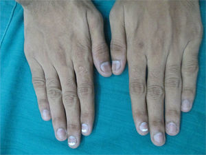 Six-month follow-up showing near complete resolution of the leukonychia.