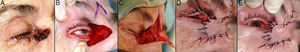 A. Carcinoma basocelular que afecta al canto interno, párpado inferior y raíz nasal derecha. B. Exéresis de la lesión, que incluye todo el canto interno. C. Diseño de un colgajo glabelar para la reconstrucción del defecto. D. Sutura parcial del colgajo, realizando una mínima incisión para adoptar la forma anatómica del canto interno. E. Resultado de la sutura completa del colgajo.
