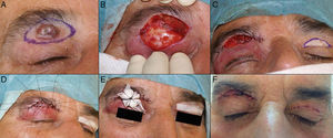 A. Carcinoma basocelular de 2,5×1,5cm en el párpado superior. B. Defecto tras la resección tumoral. C. Si se cierra directamente, produce lagoftalmos. D-E. Injerto de piel total del párpado contralateral y apósito atado. F. Resultado el día de la retirada de los puntos de sutura.