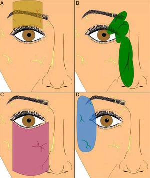 Cortesía de Dr. F. J. Vázquez Doval5. A. Infiltración de nervio supraorbitario. B. Infiltración de los nervios supratroclear e infratroclear, nasociliar y nasal externo rama del etmoidal anterior. C. Infiltración del nervio infraorbitario. D. Infiltración de los nervios cigomático facial, cigomático temporal y lacrimal.