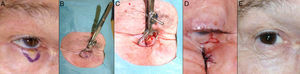 A. Resección V-bloque de espesor total y defecto menor de ¼ de párpado inferior en carcinoma basocelular incipiente. B y C. La pinza de chalazión sirve de hemostasia y ayuda a la resección de espesor total. D. Sutura del tarso y la mucosa con Vicryl 6/0 y seda 5/0. Cabos de la seda largos que evitan el roce con la córnea. E. Resultado al mes y medio de la intervención.