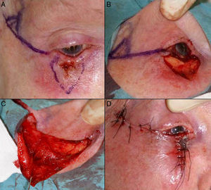 A. Carcinoma epidermoide que produce retracción y provoca ectropión. B. Resección V-bloque de espesor total con defecto mayor de ½ párpado inferior. C. Cantolisis y colgajo de avance. D. Sutura con seda 4/0 y 5/0, con cabos largos en el párpado inferior que evitan el roce con la córnea. Edema y hematoma en el párpado e hiposfagma (hemorragia subconjuntival).