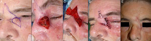 A. Carcinoma basocelular en el canto interno. Colgajo de rotación glabelar. B. Defecto en el canto interno mayor de 2cm, que no afecta a punto. C. Despegamiento del área glabelar, avance y rotación del colgajo. D. Sutura con seda 4/0 y 5/0. E. Resultado final con leve engrosamiento de parte distal del colgajo.