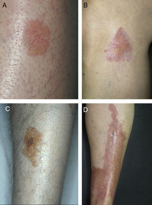 Lesiones típicas de necrobiosis lipoídica en las extremidades inferiores, con predominio de telangiectasias (A, B), coloración amarillenta (C) y atrofia (D).