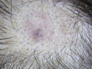 Imagen clínica de la lesión localizada en el ápex del cuero cabelludo. Se trata de una mácula asintomática de color pardo con bordes mal definidos.