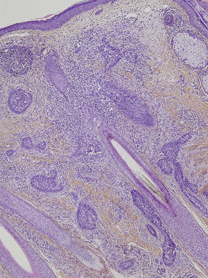 Microfotografía histológica donde se pueden observar nidos y cordones de células basaloides infiltrando la dermis junto a un folículo piloso cortado longitudinalmente (hematoxilina-eosina ×40).