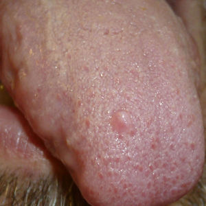 Nódulo bien delimitado eritematoso de 2mm de diámetro en el dorso de la lengua.