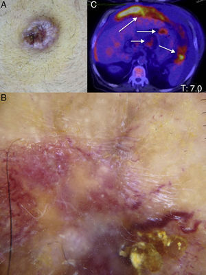 A) Nódulo eritematoso localizado en ombligo. B) Examen dermatoscópico: patrón vascular polimorfo. C) Imagen de tomografía por emisión de positrones: masa tumoral localizada en ángulo hepático de colon con metástasis en hígado, ombligo y espacio peritoneal.