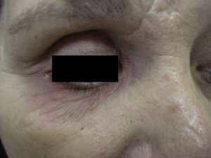 Eczema palpebral afectando al párpado móvil superior y al párpado inferior.