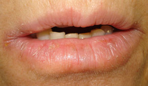 Queilitis fisurada crónica.